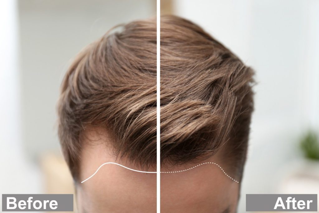 Ein before/after Bild des gleichen Kopfes eines jungen Mannes, in der Mitte durch einen weissen Balken vertikal geteilt: Links vorher, rechts nach der Behandlung