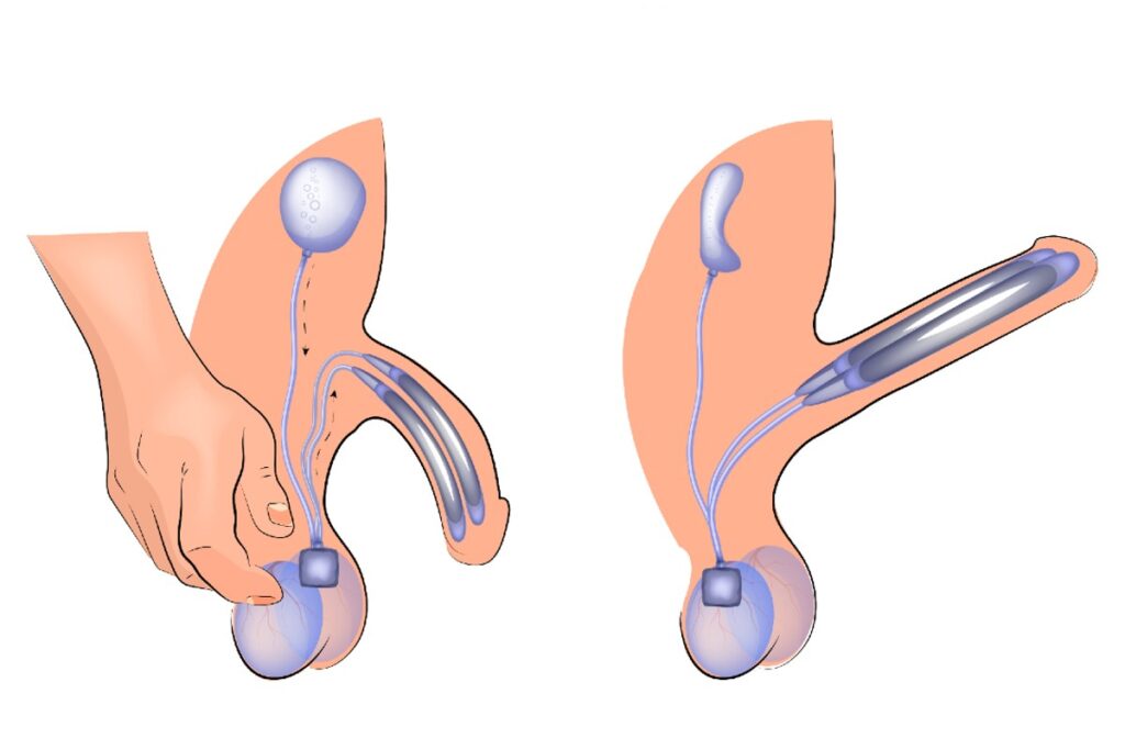 Grafik der Funktionsweise einer Penispumpe