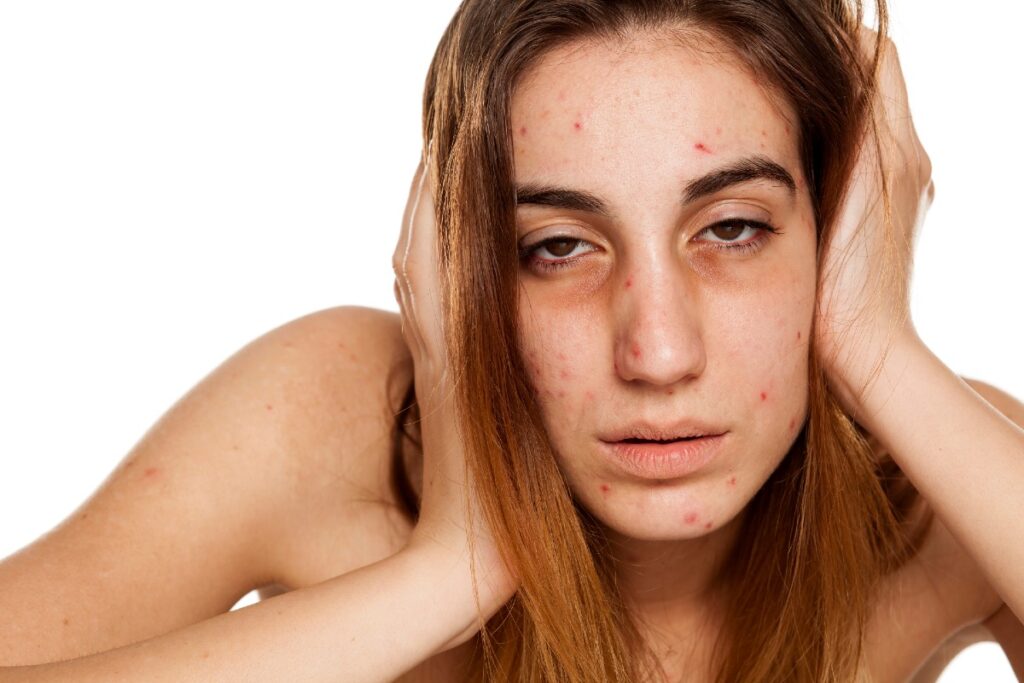 Müde blickende junge Frau mit Akne