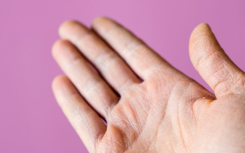 Handfläche, deren Haut trocken ist und sich schuppt