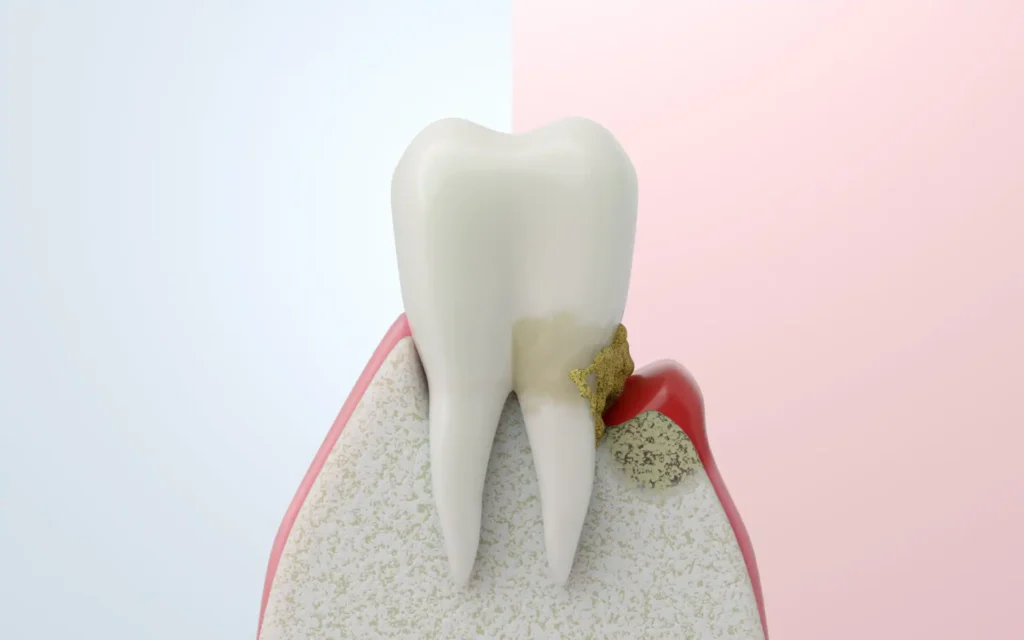 Modell eines Zahns mit Schäden