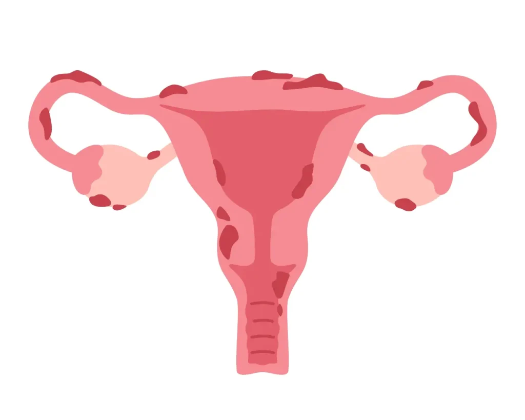 Grafische Darstellung einer gebärmutte rmit Endometriose