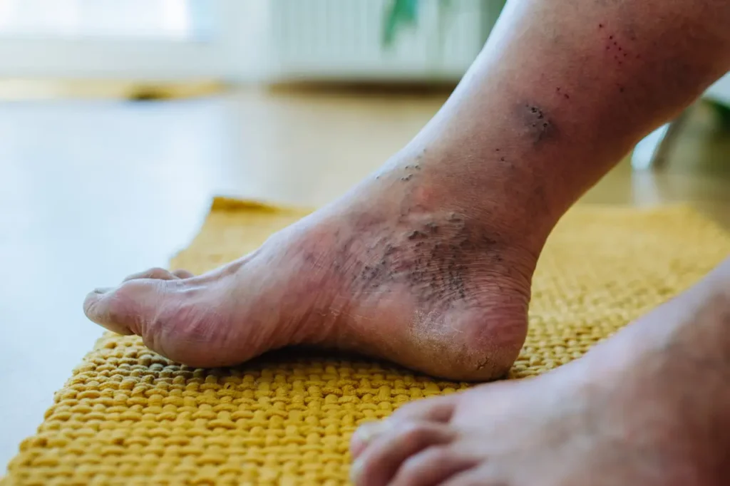 Fuss einer Frau mit Diabetes