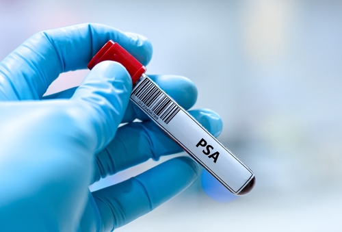 Tube de prélèvement sanguin utilisé pour l’analyse du taux de PSA dans le dépistage du cancer de la prostate
