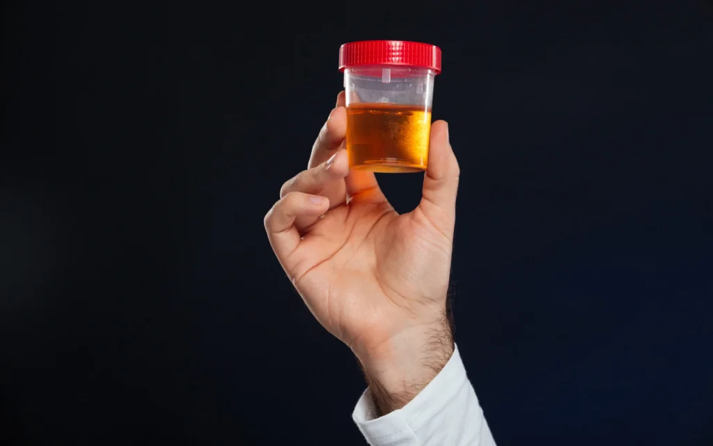 Hand hält einen transparenten Probenbecher mit dunkelgelb bis orange verfärbtem Urin vor dunklem Hintergrund.