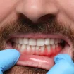 Mann bein Zahnarzt mit Zahnfleischentzündung