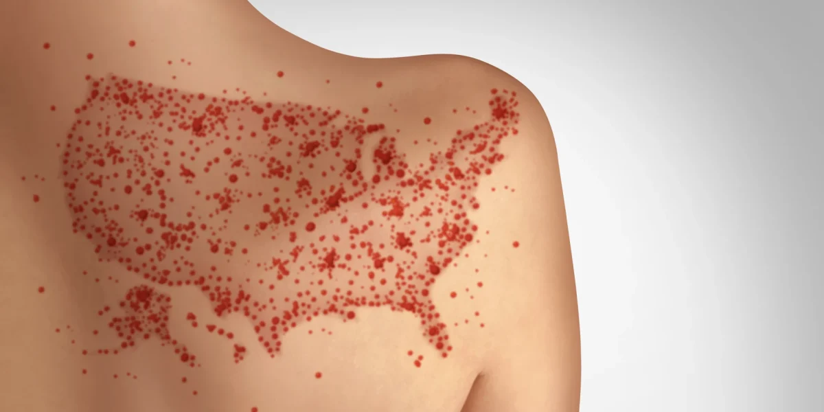 Masernausbruch in den USA als Masernausbruch dargestellt