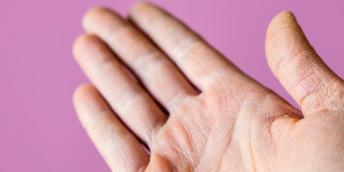 Handfläche, deren Haut trocken ist und sich schuppt